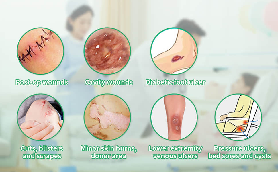 Calcium Alginate Wound Dressing Calcium Alginate Wound Dressing